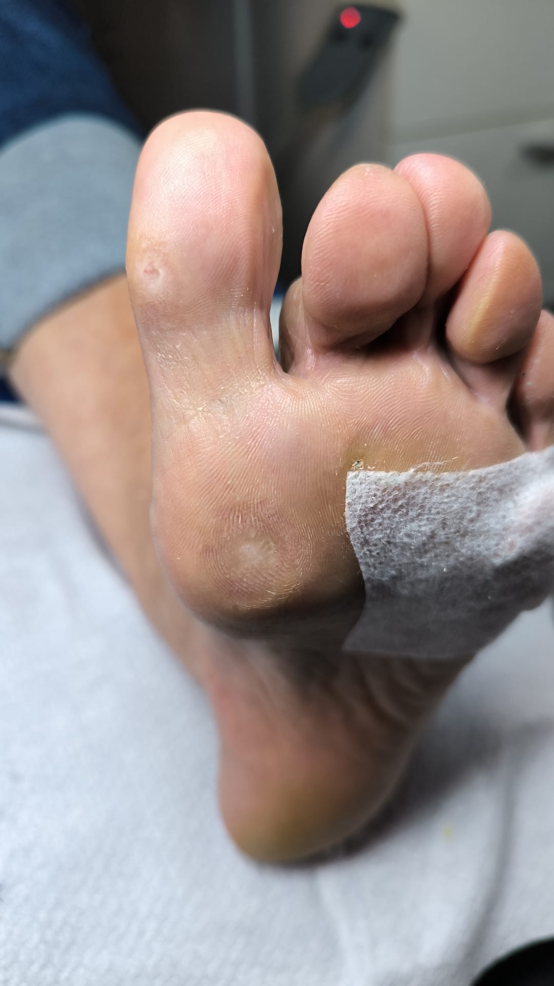 Bătături – hiperkeratoză plantară