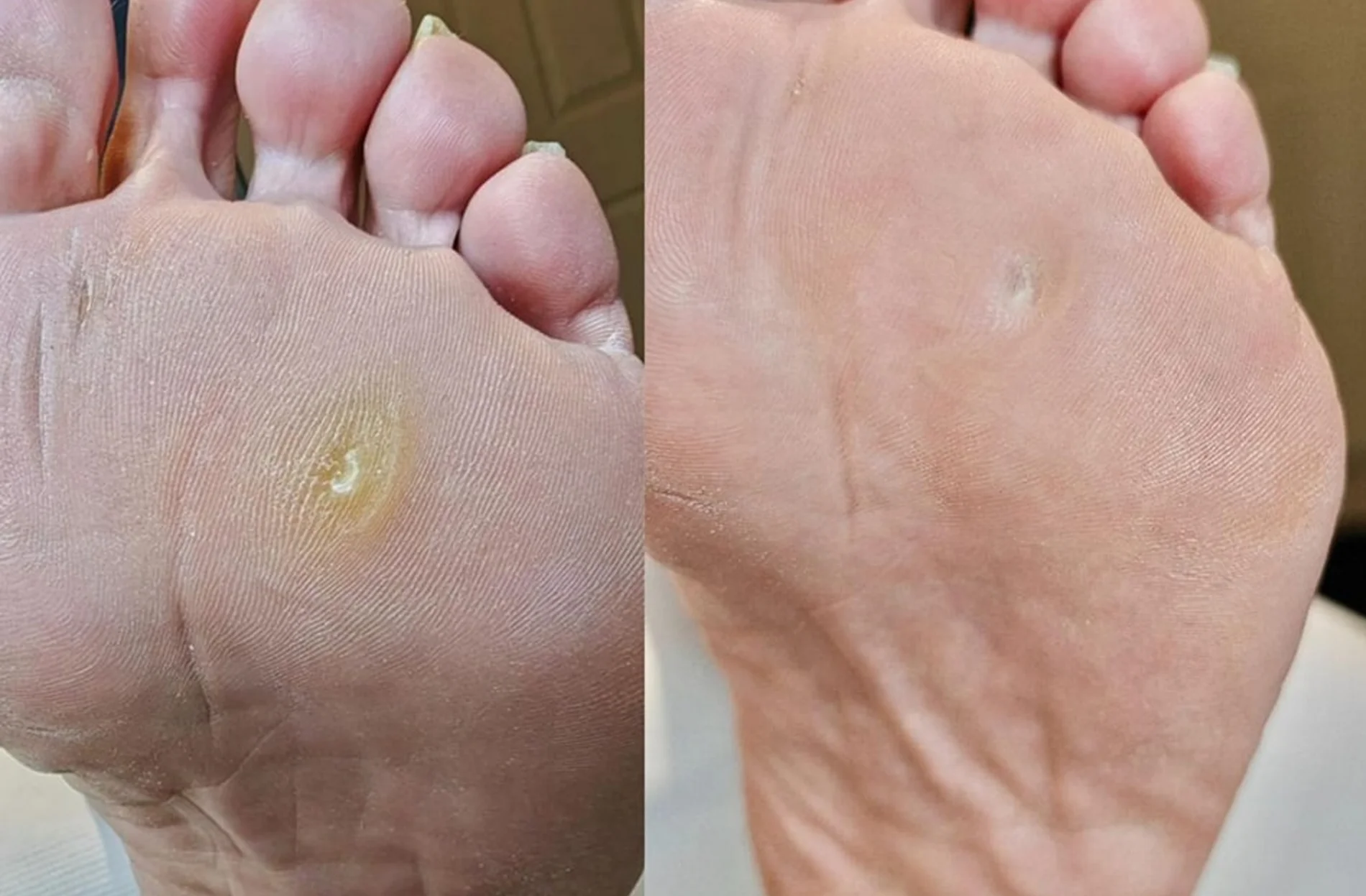 Clavus plantar – bătătură