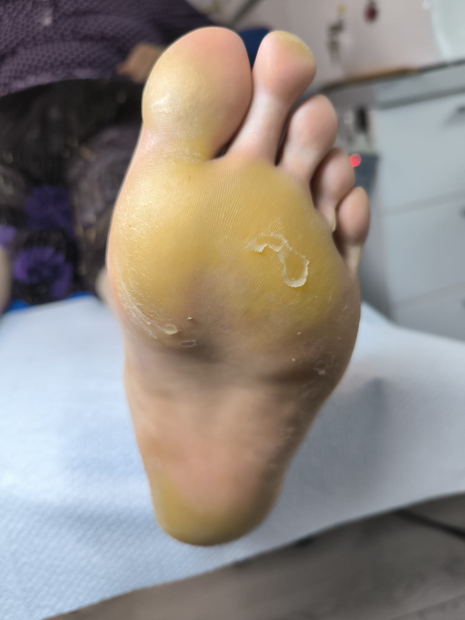Hiperkeratoză – piele îngroșată