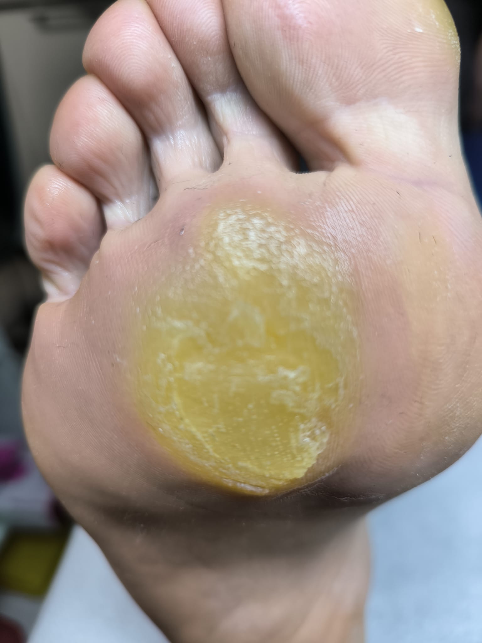 Hiperkeratoză – evoluție tratament