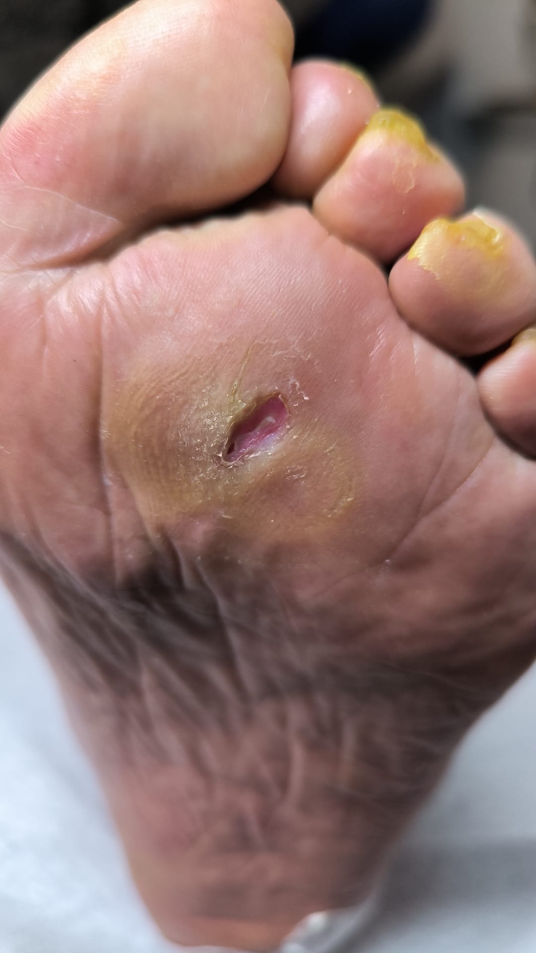 Îngrijirea piciorului diabetic