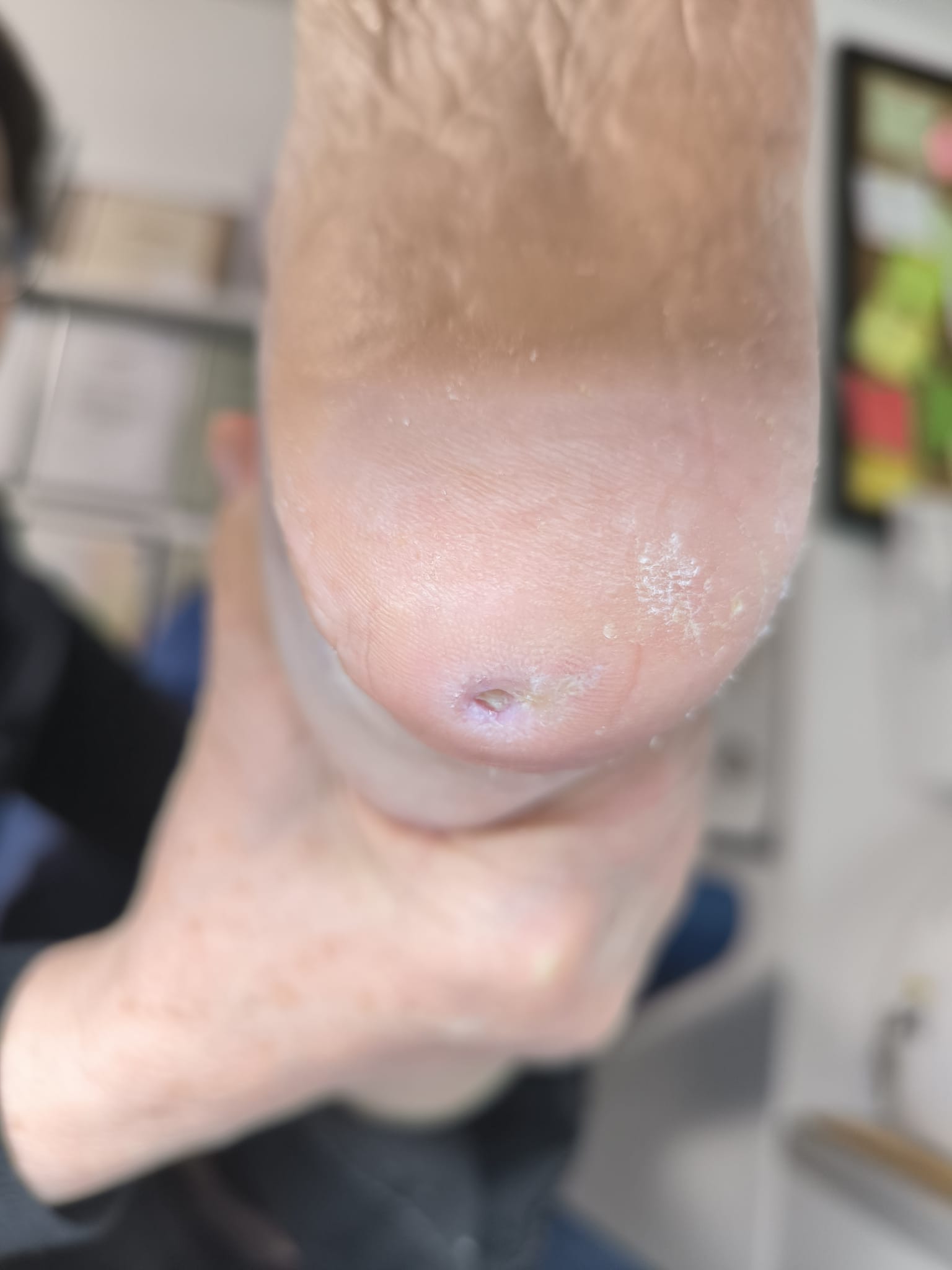 Picior diabetic – protocoale de îngrijire