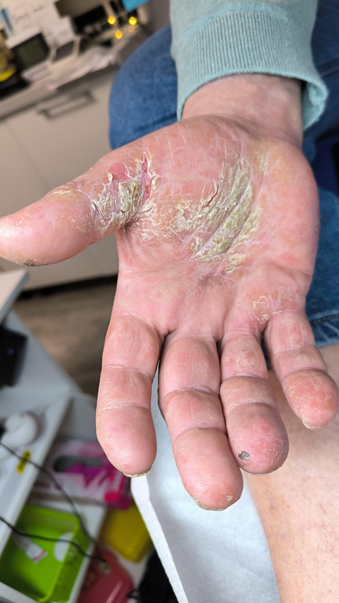 Psoriazis – manifestări la nivelul unghiilor