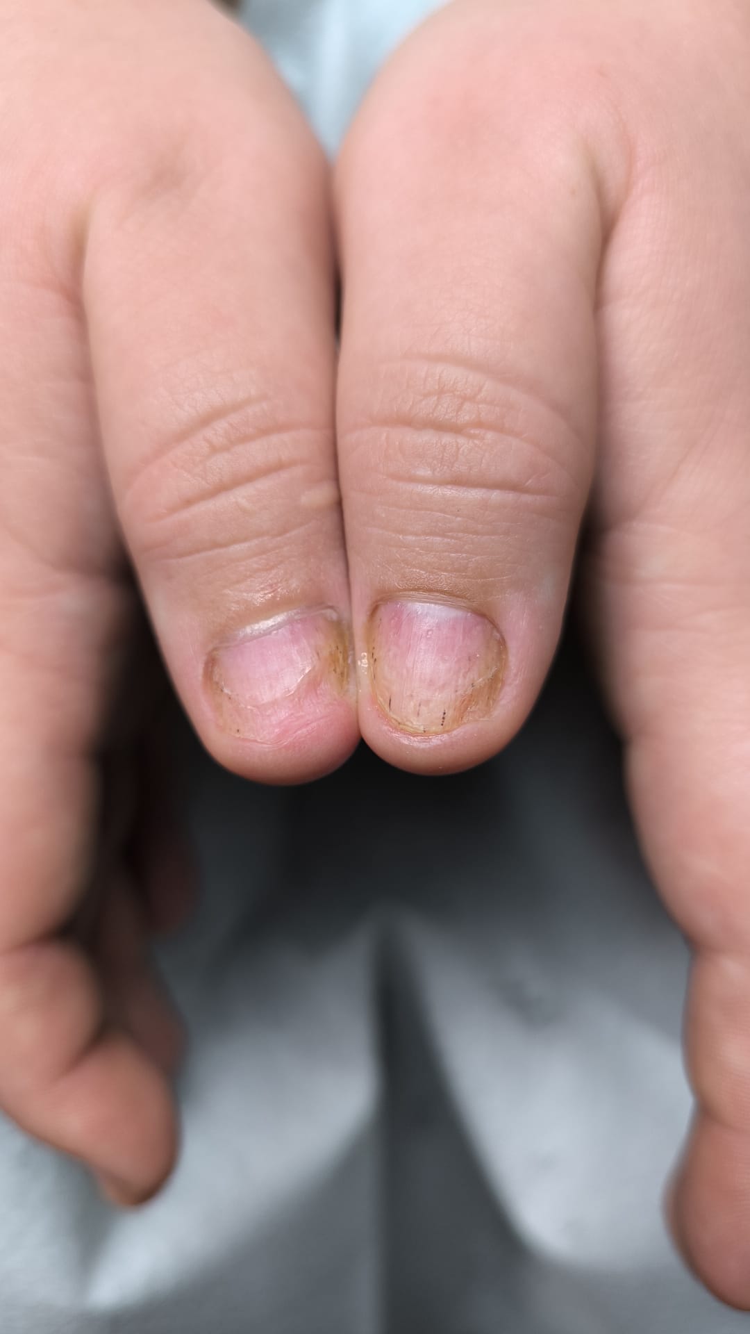 Psoriazis – leziuni cronice