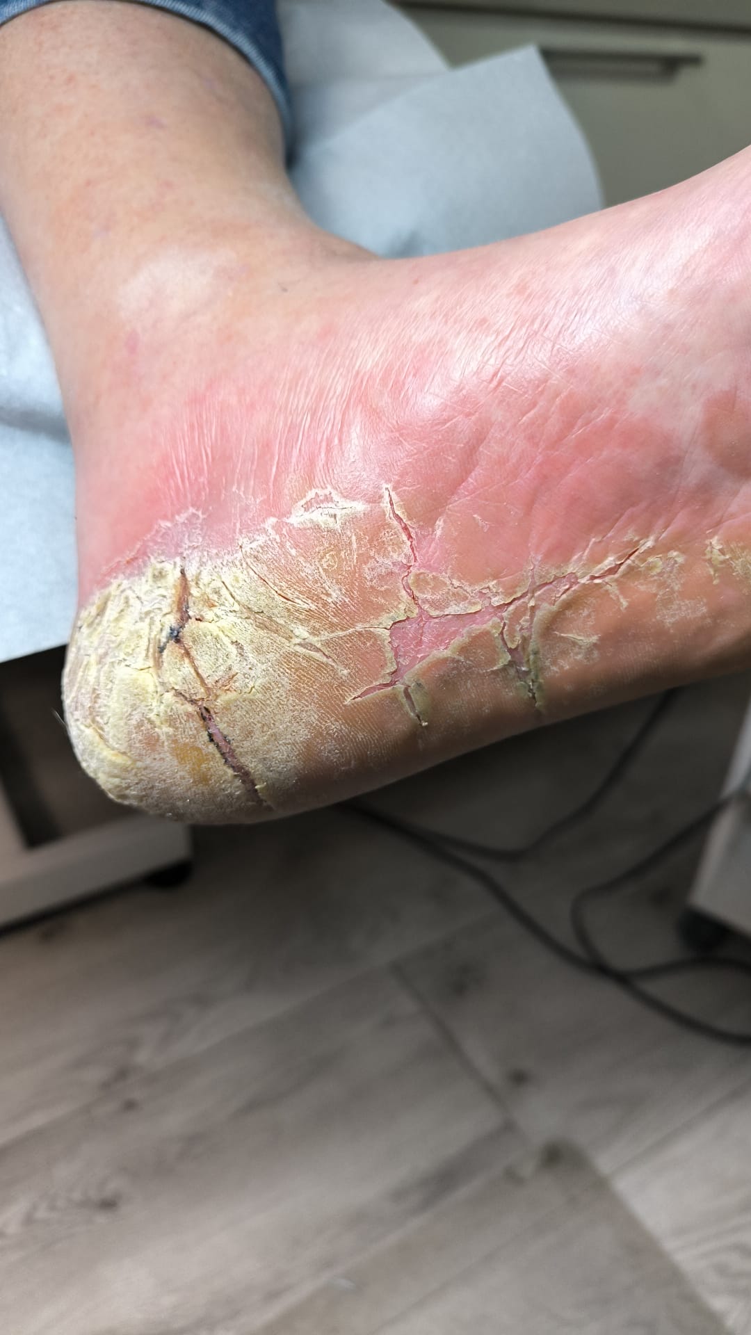 Psoriazis unghial și cutanat