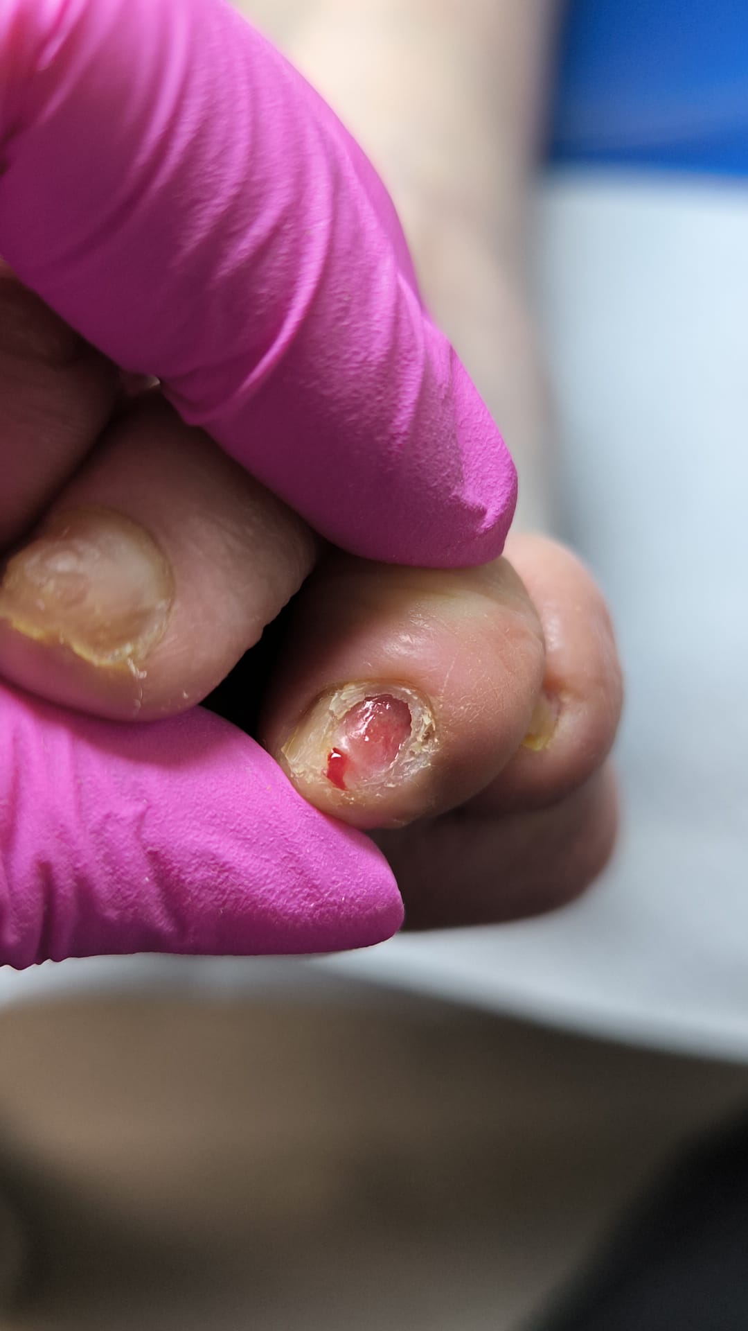 Ulcer – leziune cutanată periferică