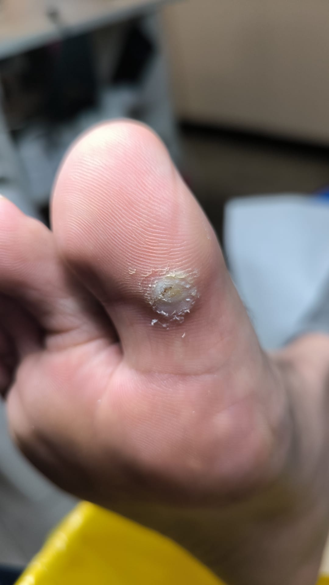 Verucă plantară – evoluție tratament